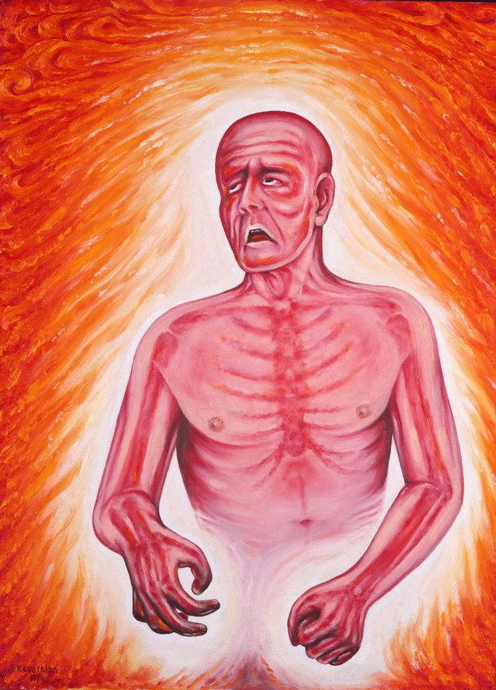 Fever by Jack Kevorkian-American Painting